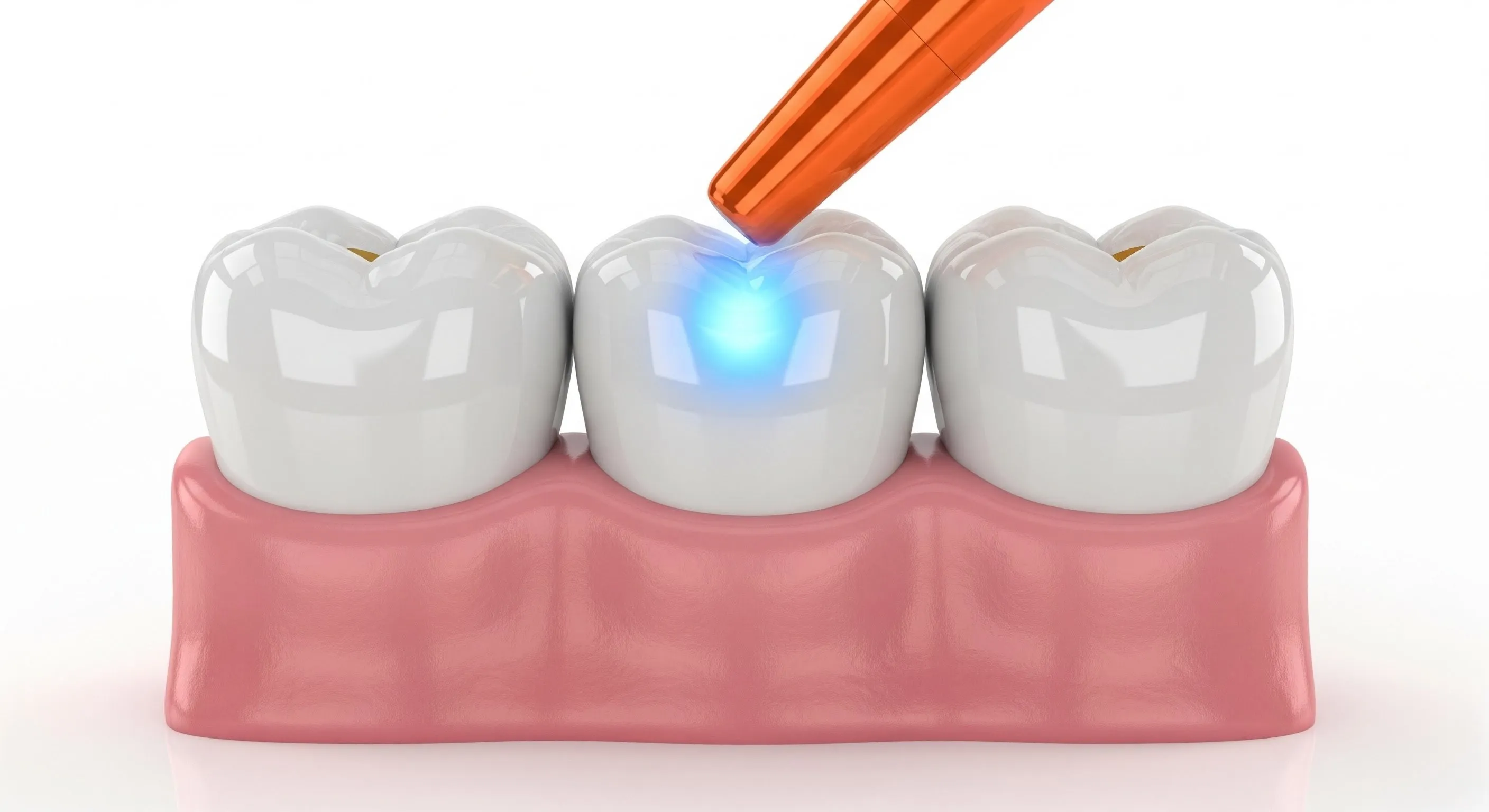 Composite Fillings Cost and Pricing Information in Greenville